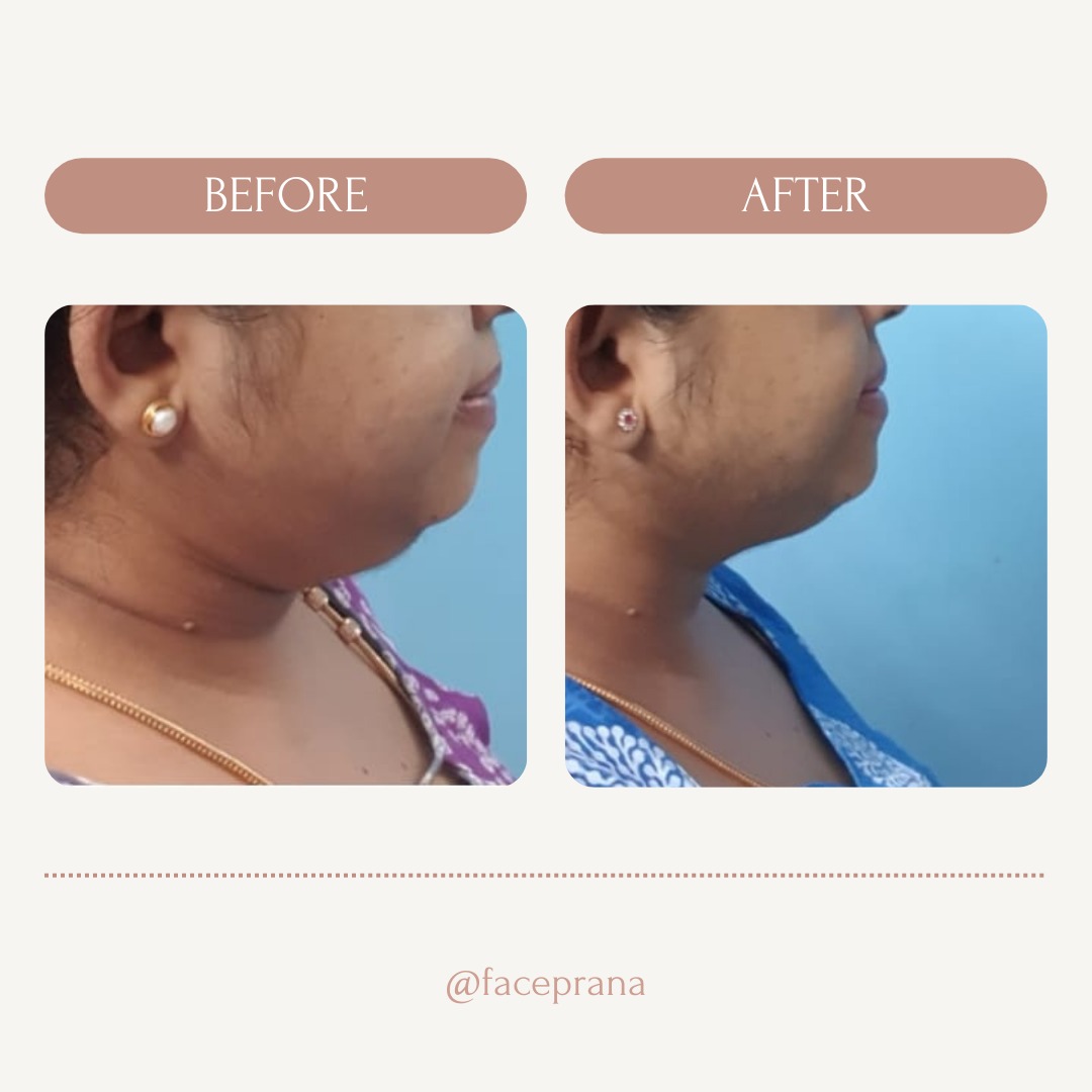 Reduction in Double Chin and Neck Lines