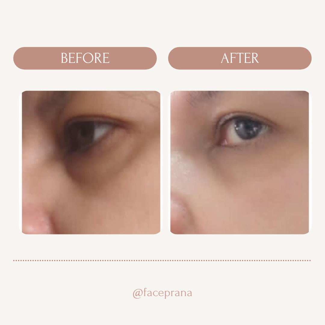 Reduction in Eye Bags and Puffy Eyes