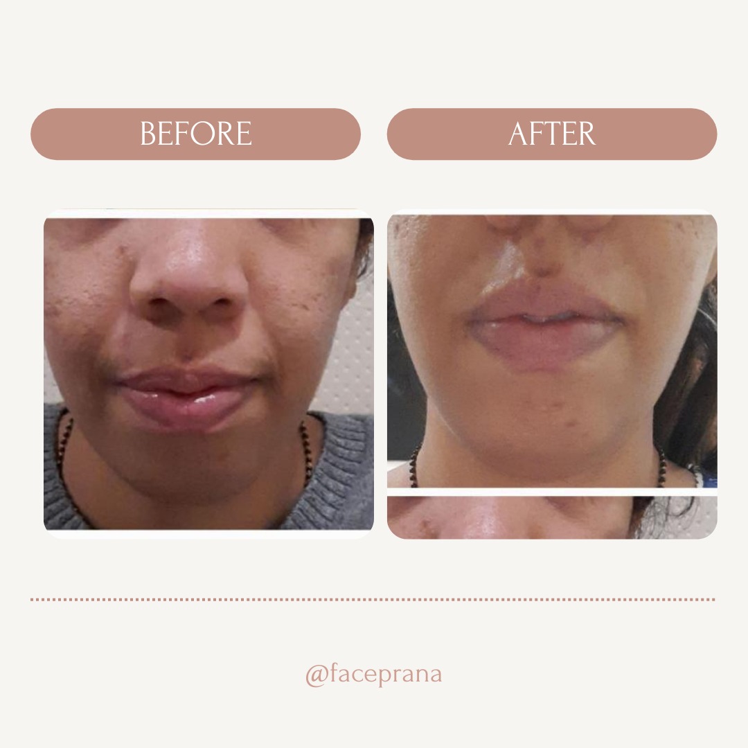 Reduction is Smile lines, open pores, uneven skin tone, pigmented lips